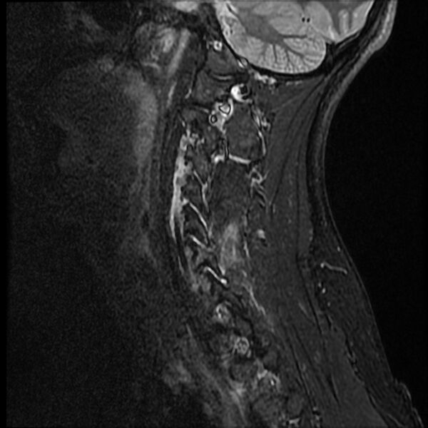 File:Cervical facet fracture and anterior discoligamentous injury (Radiopaedia 32139-33084 Sagittal STIR 2).jpg