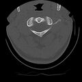 Cervical flexion teardrop fracture with cord hemorrhage (Radiopaedia 32497-33454 Axial bone window 19).jpg