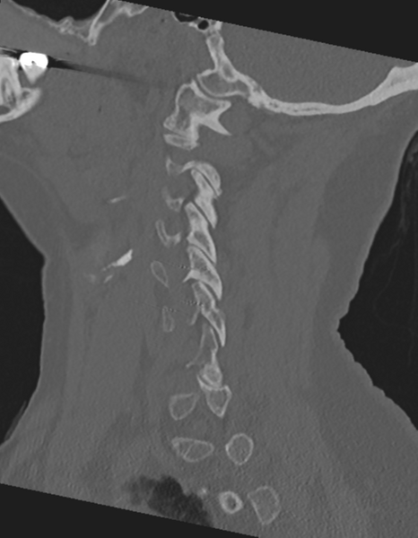 File:Cervical spine ACDF loosening (Radiopaedia 48998-54071 Sagittal bone window 29).png