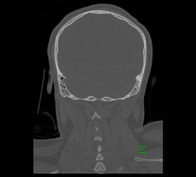 File:Cervical spine fracture - hyperflexion injury (Radiopaedia 66184-75364 Coronal bone window 15).jpg