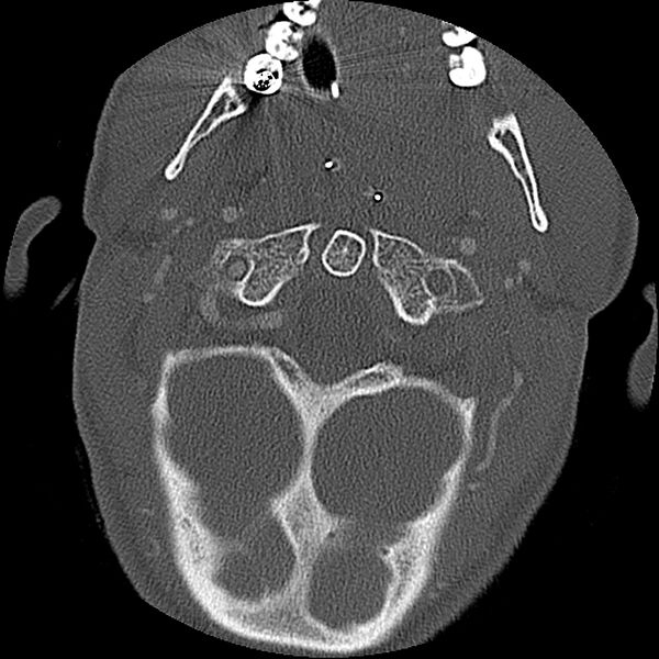 File:Cervical spine fractures with vertebral artery dissection (Radiopaedia 32135-33078 Axial bone window 68).jpg