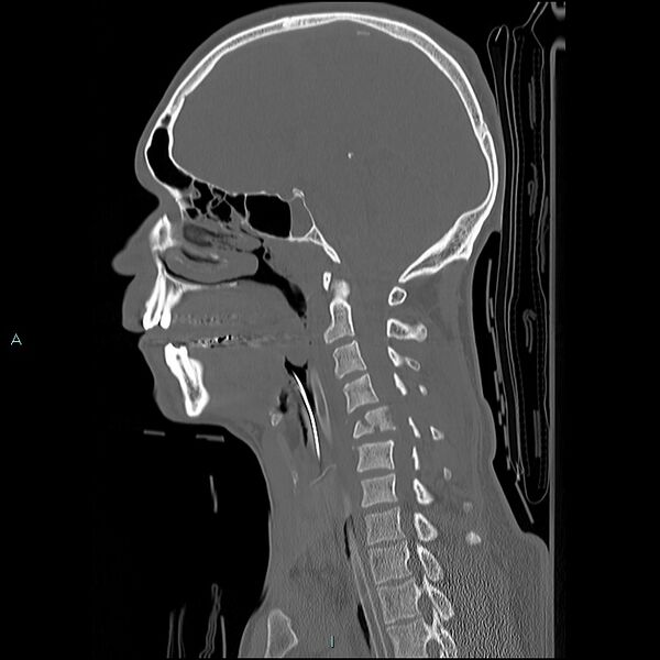 File:Cervical vertebral burst fracture (Radiopaedia 37420-39258 Sagittal bone window 12).jpg