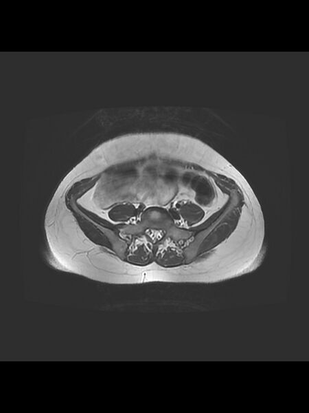 File:Cesarean section scar endometrioma (Radiopaedia 56569-63297 Axial T2 1).jpg