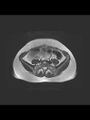 Cesarean section scar endometrioma (Radiopaedia 56569-63297 Axial T2 1).jpg