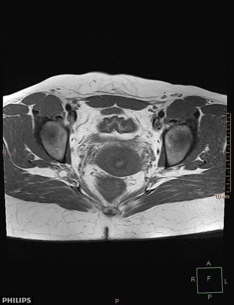 File:Cesarian scar endometriosis (Radiopaedia 68495-78066 Axial T1 16).jpg