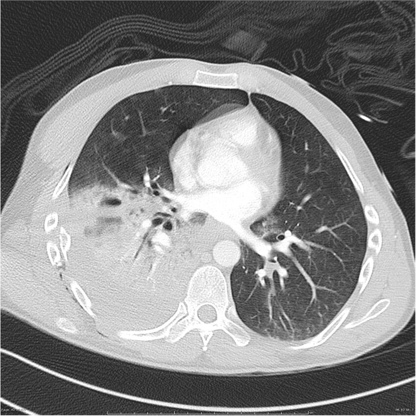 Chest and abdomen multi-trauma (Radiopaedia 26294-26425 lung window 62).jpg