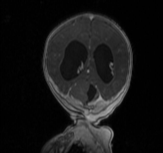 File:Chiari III malformation with occipital encephalocele (Radiopaedia 79446-92559 Coronal T1 C+ mpr 31).jpg