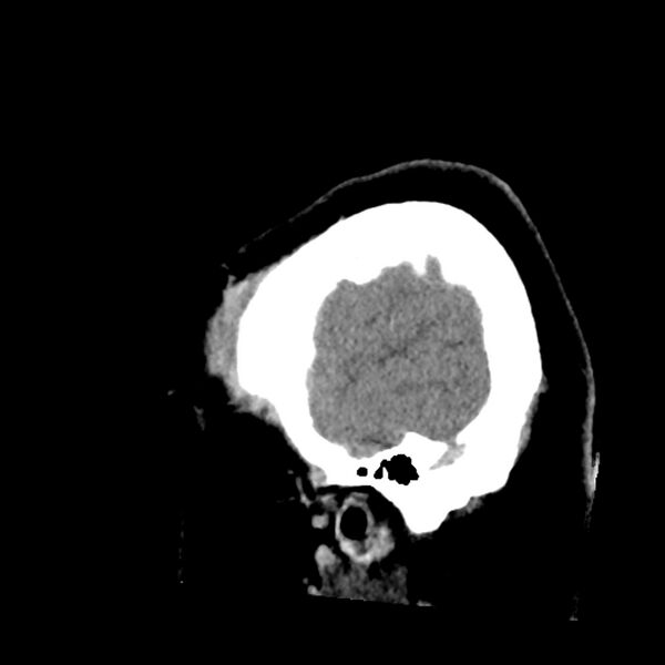 File:Chiasmatic-hypothalamic juvenile pilocytic astrocytoma (Radiopaedia 78533-91237 B 11).jpg
