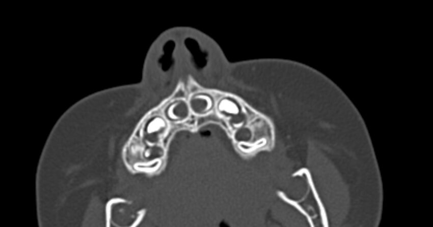 Choanal atresia (Radiopaedia 51295-56972 Axial bone window 2).jpg