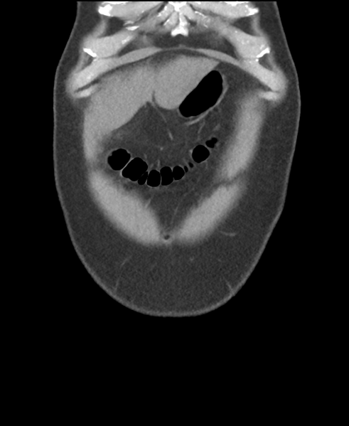 File:Cholecystitis with focal perforation and hepatic abscess (Radiopaedia 37189-38945 Coronal non-contrast 8).png