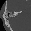 Cholesteatoma (Radiopaedia 15846-15494 bone window 5).jpg