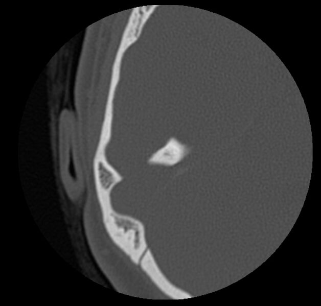 File:Cholesteatoma (Radiopaedia 20296-20217 bone window 38).jpg
