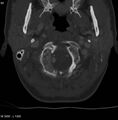 Chondroblastoma - occipital condyle (Radiopaedia 5569-7304 bone window 8).jpg