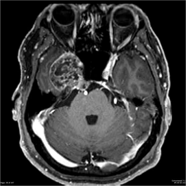 File:Chondrosarcoma of skull base- grade II (Radiopaedia 40948-43654 Axial T1 C+ 26).jpg