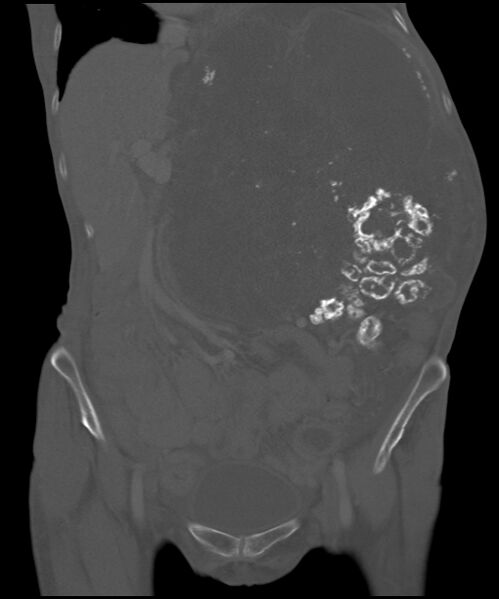 File:Chondrosarcoma of the spine (Radiopaedia 49871-55143 Coronal bone window 24).jpg