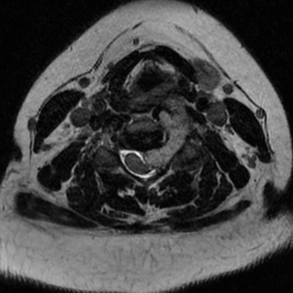 File:Chordoma - cervical spine (Radiopaedia 70084-80111 Axial T2 48).png