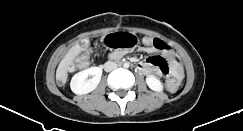 File:Choriocarcinoma liver metastases (Radiopaedia 74768-85766 A 111).jpg