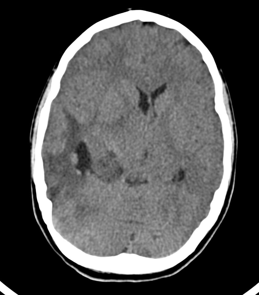 Choroid plexus carcinoma (Radiopaedia 91013-108552 Axial non-contrast 28).jpg