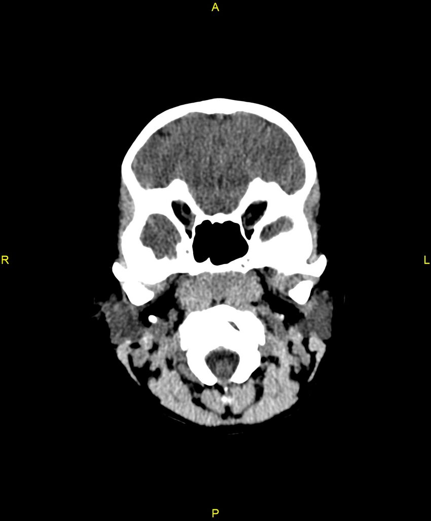 Choroidal fissure cyst (Radiopaedia 89481-106465 Axial non-contrast 21).jpg