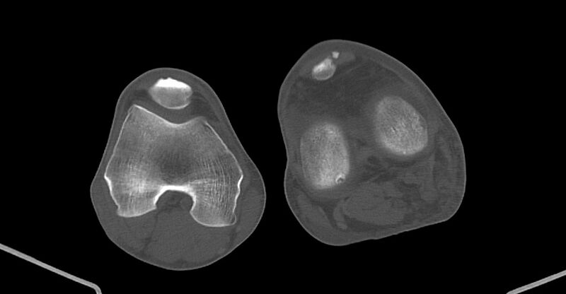 File:Chronic osteomyelitis (with sequestrum) (Radiopaedia 74813-85822 Axial non-contrast 187).jpg