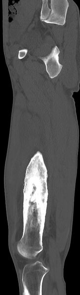 File:Chronic osteomyelitis (with sequestrum) (Radiopaedia 74813-85822 C 73).jpg