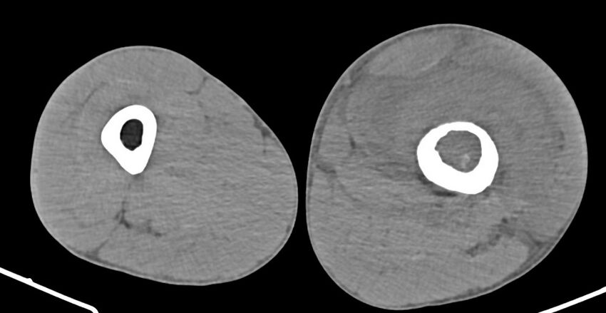 Chronic osteomyelitis (with sequestrum) (Radiopaedia 74813-85822 D 99).jpg
