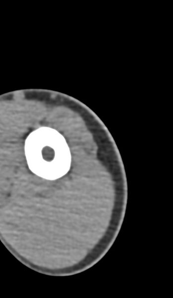File:Chronic osteomyelitis of the distal humerus (Radiopaedia 78351-90971 Axial 248).jpg