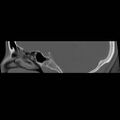 Chronic otomastoiditis (Radiopaedia 27138-27309 Sagittal bone window 28).jpg
