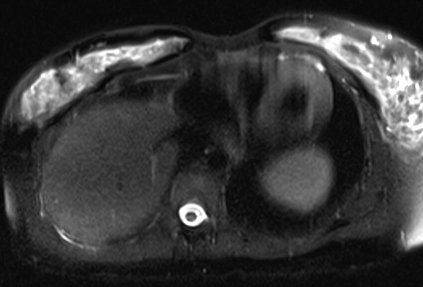Chronic pancreatitis - pancreatic duct calculi (Radiopaedia 71818-82250 Axial T2 fat sat 5).jpg