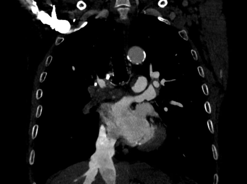 File:Chronic pulmonary embolism (Radiopaedia 91241-108843 A 54).jpg