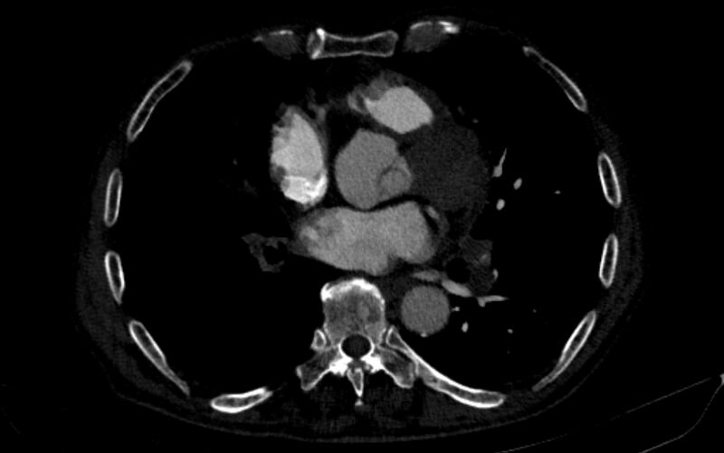 File:Chronic pulmonary embolism (Radiopaedia 91241-108843 B 113).jpg
