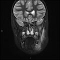 Chronic reactive multifocal osteomyelitis (CRMO) - mandible (Radiopaedia 56405-63069 Coronal STIR 14).jpg