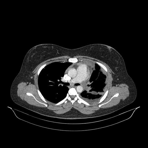 File:Chronic thromboembolic pulmonary hypertension (CTEPH) (Radiopaedia 74597-85532 Axial C+ CTPA 100).jpg