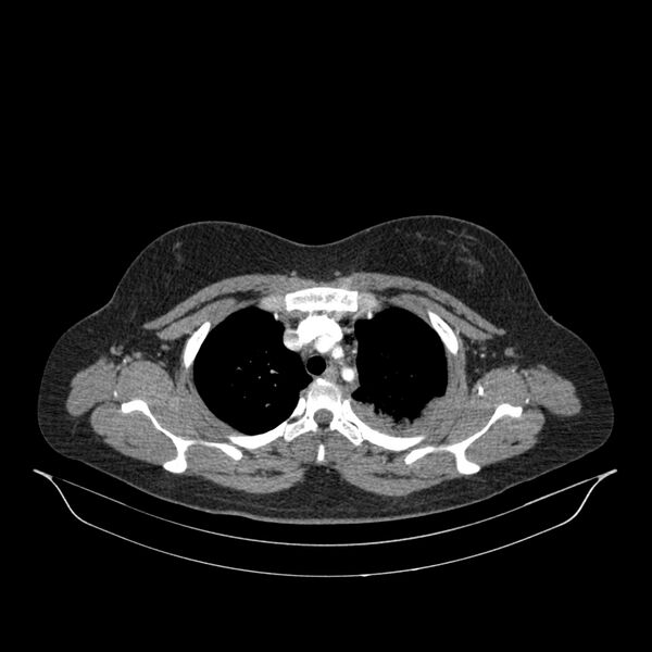 File:Chronic thromboembolic pulmonary hypertension (CTEPH) (Radiopaedia 74597-85532 Axial C+ CTPA 125).jpg