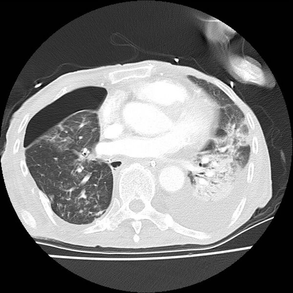 File:Clagett thoracotomy with bronchopleural fistula (Radiopaedia 29192-29587 Axial lung window 30).jpg