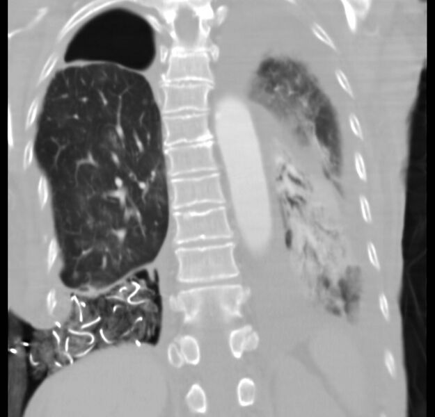 File:Clagett thoracotomy with bronchopleural fistula (Radiopaedia 29192-29587 Coronal lung window 8).jpg