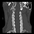 Clay-shoveler fracture (Radiopaedia 22568-22590 Coronal bone window 17).jpg