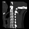 Clay-shoveler fracture (Radiopaedia 22568-22590 Sagittal MIP 12).jpg