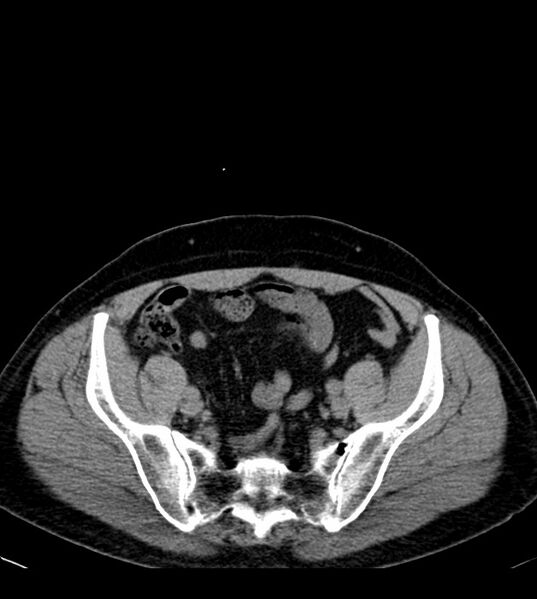 File:Clear cell renal cell carcinoma (Radiopaedia 85006-100539 Axial non-contrast 70).jpg