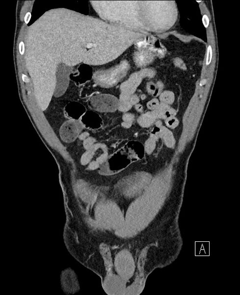 File:Closed loop small bowel obstruction - internal hernia (Radiopaedia 57806-64778 A 30).jpg