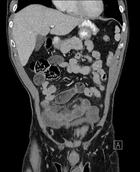 File:Closed loop small bowel obstruction - internal hernia (Radiopaedia 57806-64778 A 35).jpg