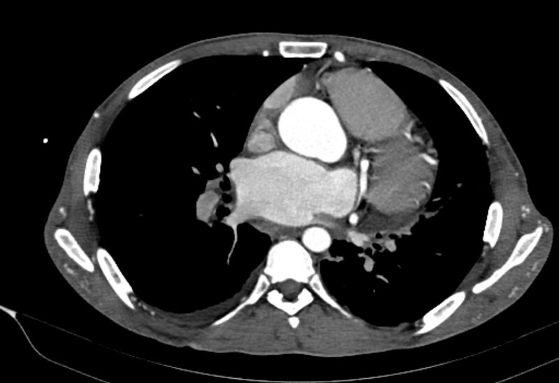 File:Coarctation of aorta with aortic valve stenosis (Radiopaedia 70463-80574 A 108).jpg
