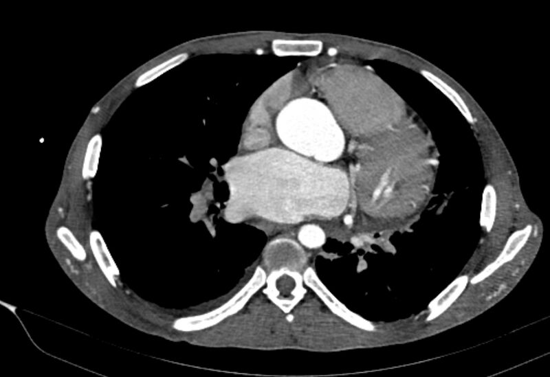 File:Coarctation of aorta with aortic valve stenosis (Radiopaedia 70463-80574 A 112).jpg