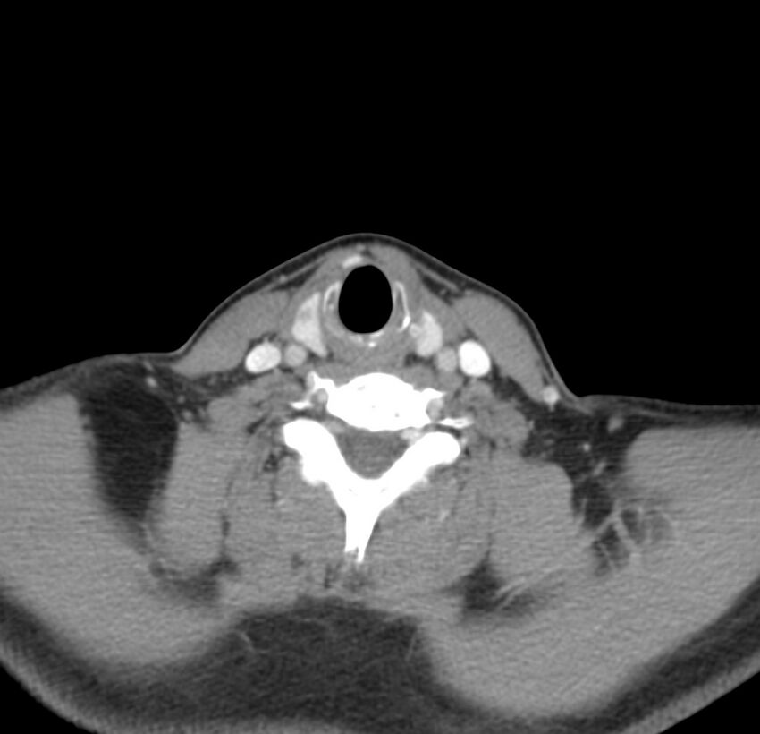 Colloid cyst of thyroid (Radiopaedia 22897-22923 Axial C+ delayed 55).jpg