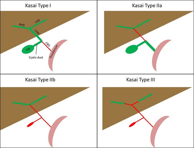 File:Kasai classification of biliary atresia (diagram) (Radiopaedia 68273).jpg