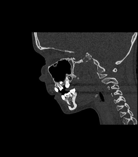 File:Nasoorbitoethmoid fracture (Radiopaedia 90044-107205 Sagittal bone window 59).jpg