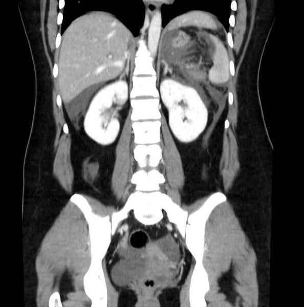 File:Necrotizing pancreatitis (Radiopaedia 23001-23031 B 44).jpg