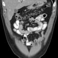 Necrotizing pancreatitis with acute necrotic collection (Radiopaedia 14470-14417 C 5).jpg