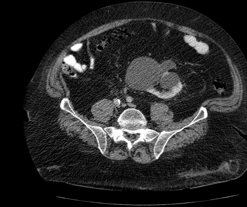 Nephroptosis with inguinal hernia containing perirenal fat (Radiopaedia 56632-63391 C 242).jpg