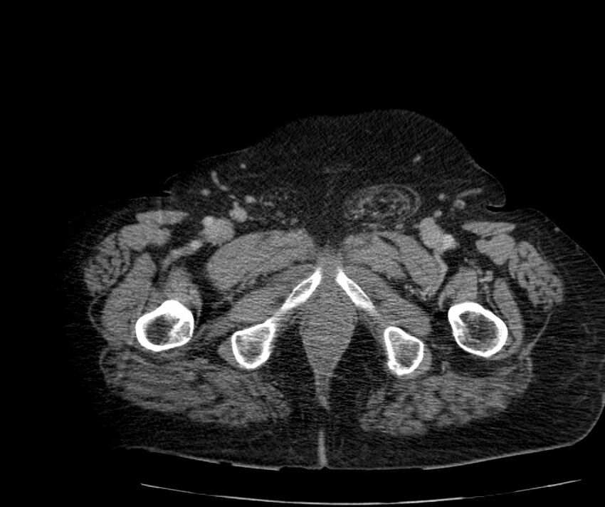 Nephroptosis with inguinal hernia containing perirenal fat (Radiopaedia 56632-63391 C 344).jpg